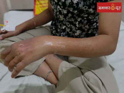 उज्जैन में हाईटेंशन लाइन की चपेट में आईं दो बच्चियां:खेलते समय एक ने तार पकड़ा, बचाने गई दूसरी भी झुलसी; दोनों भर्ती